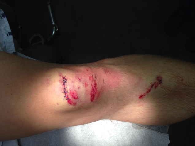 Knee after cleanup and stitching